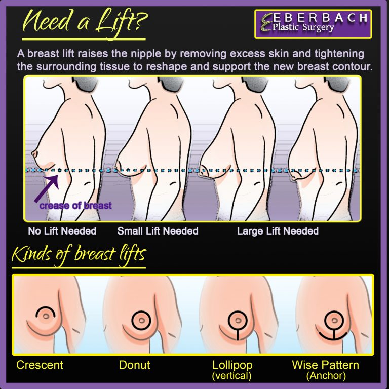 Breast Lift Tampa Bay