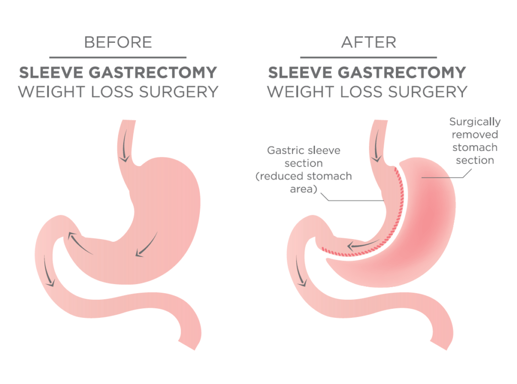 Before and After Graphic of Sleeve Gastrectomy for Weight Loss
