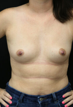 Breast Augmentation - 300cc-399cc
