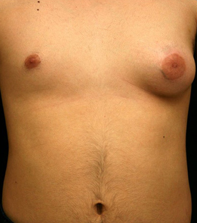 Male Breast Reduction (Before)
