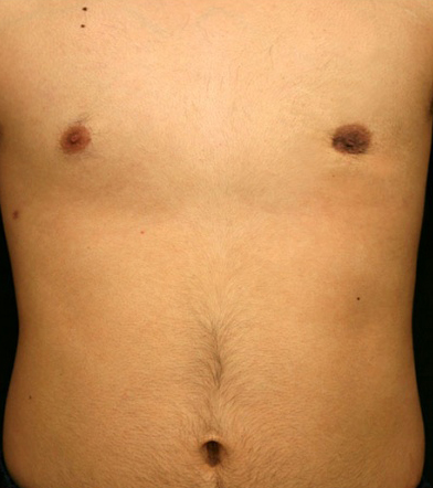 Male Breast Reduction (After)