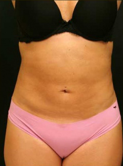 Liposuction Procedure | Abdominoplasty-Excess Body Fat Removal (After)