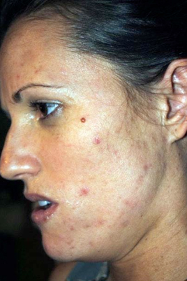 DiamondGlow - Acne Treatment (Before)