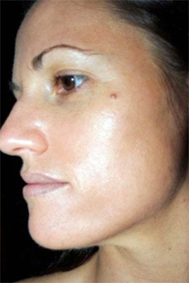 DiamondGlow - Acne Treatment (After)