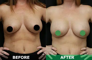 Breast Implant Exchange