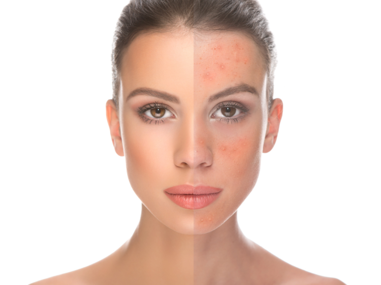 Peels | Effectively Target Acne, and Blemishes for Glowing Skin