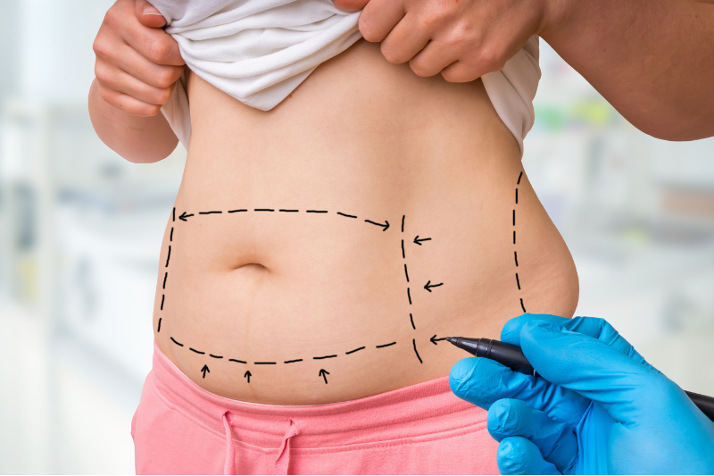 Tummy Tuck Procedure