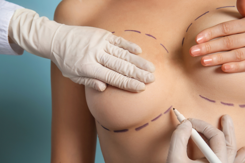 Breast Augmentation and Breast Lift Surgery