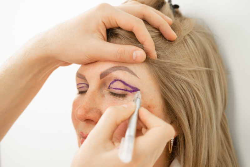 Blepharoplasty