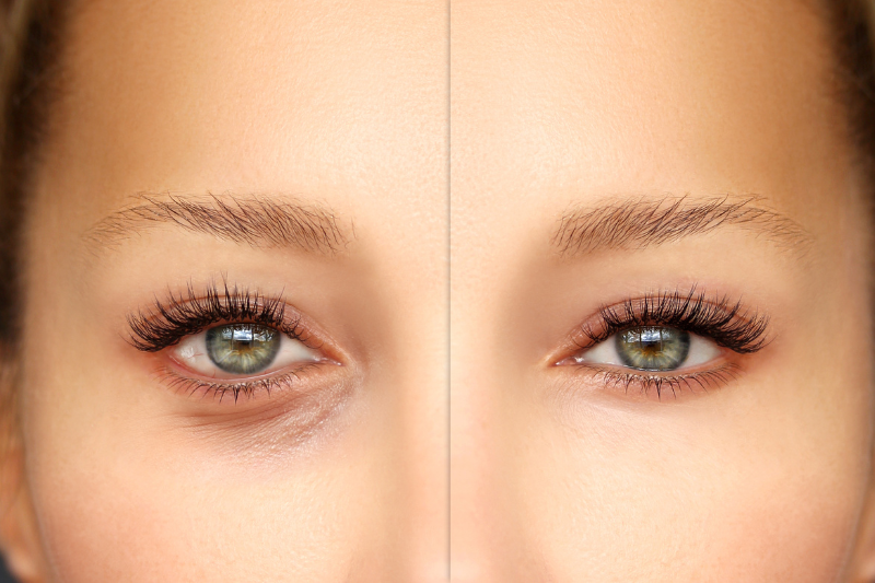 Blepharoplasty | A Comprehensive Guide to Eyelid Surgery