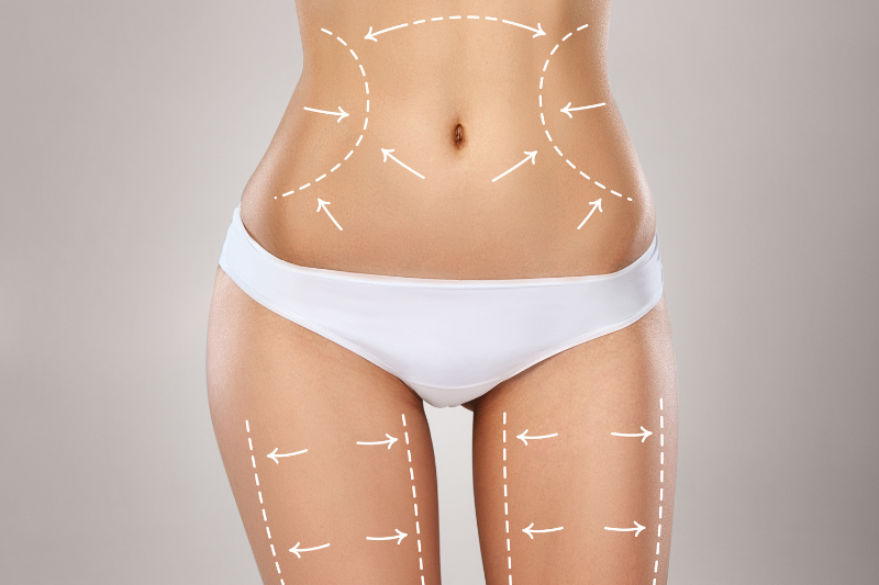 Liposuction