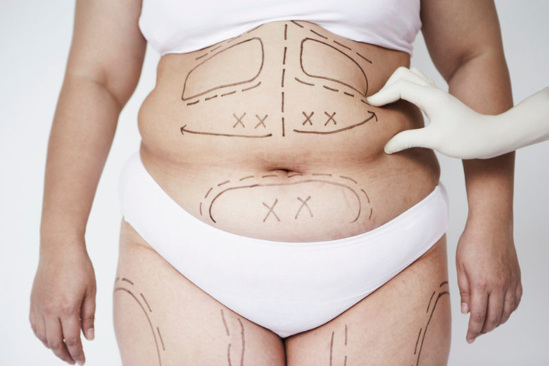 Liposuction and Lipoplasty Surgery