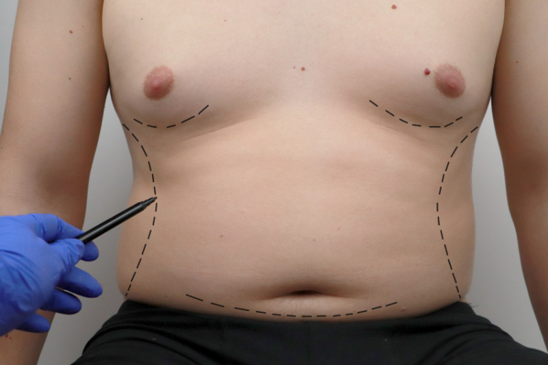 gynecomastia - Male Breast Cancer