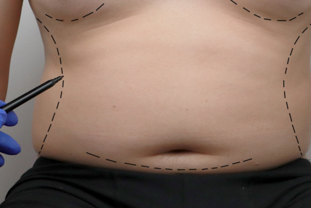 Male liposuction