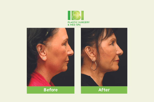 Facelift vs. Neck Lift