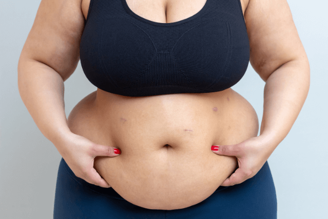 Tummy Tuck vs Liposuction