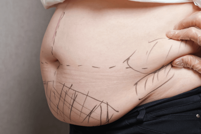 Recovery Tips After Liposuction