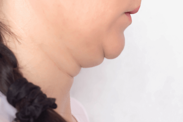 Double Chin Surgery