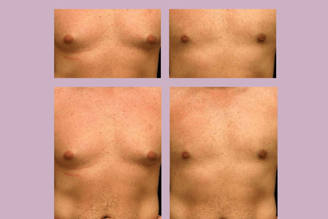 Male Breast Reduction Surgery before and after.png