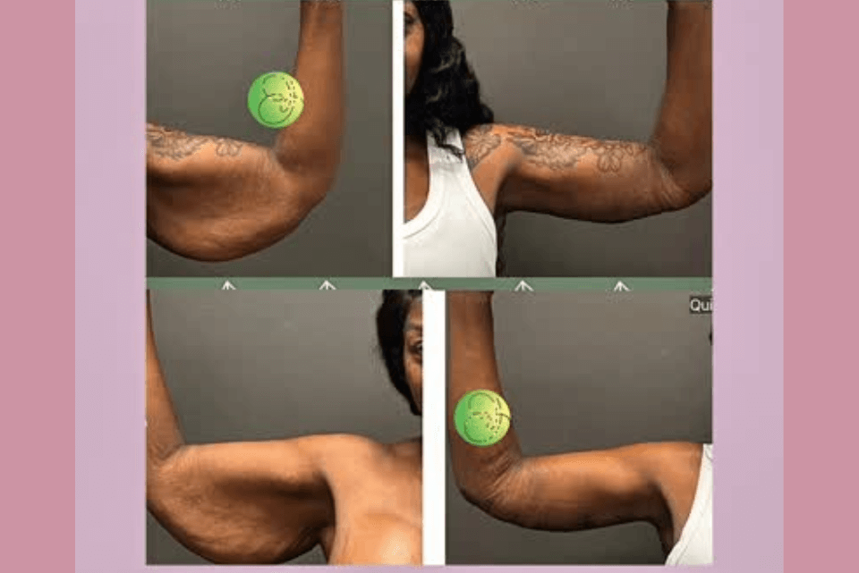 What Is an Arm Lift After Weight Loss?