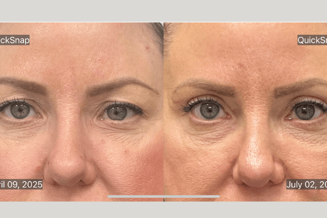 What is Blepharoplasty?