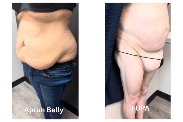 Apron Belly vs. FUPA