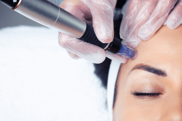 Microneedling in Hudson