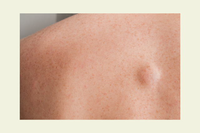 What Is a Lipoma?