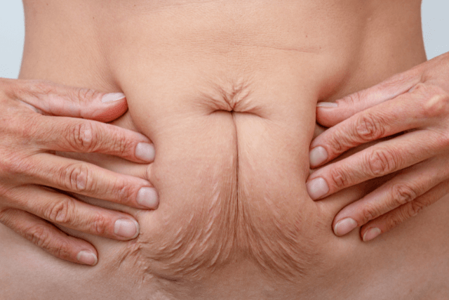 Non-Surgical Skin Tightening