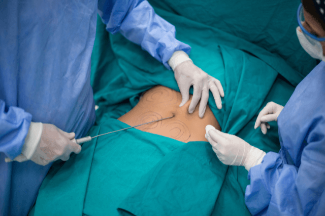 Deciding between a tummy tuck vs. liposuction?
