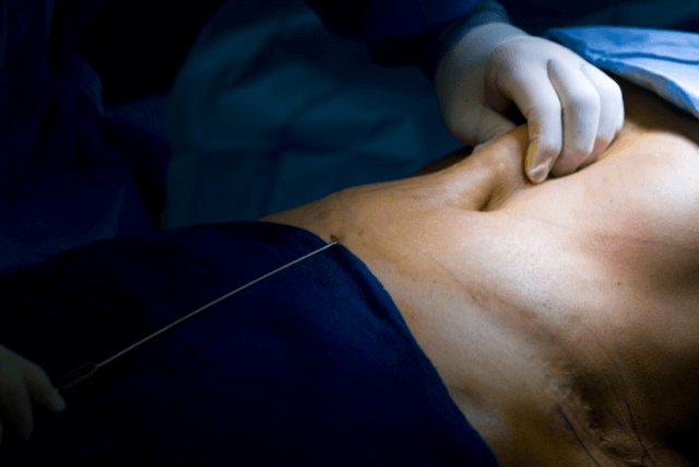 Does Liposuction Leave Scars