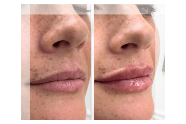 Facial Balancing with Fillers