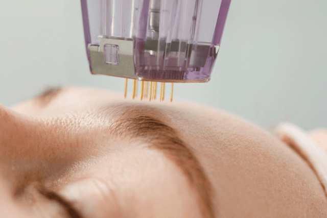 Microneedling and PRP