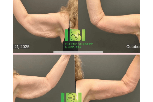 Am I a Good Candidate for an Arm Lift?