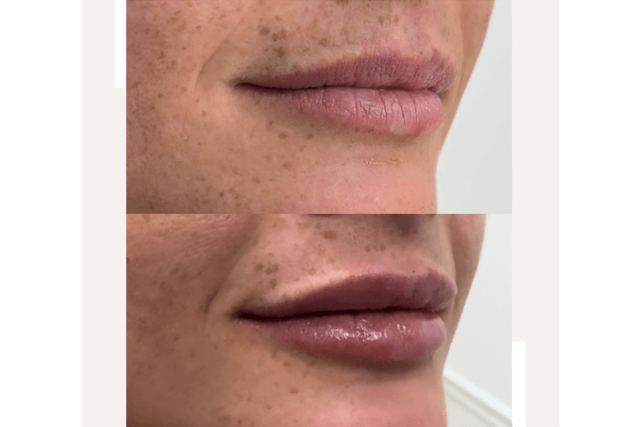 Are Dermal Fillers Safe?