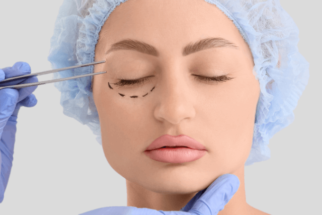 Upper Blepharoplasty