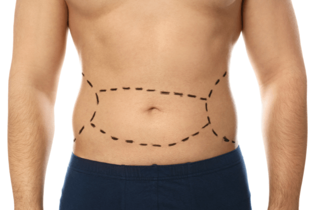 Tummy Tuck for Men in Hudson, Florida