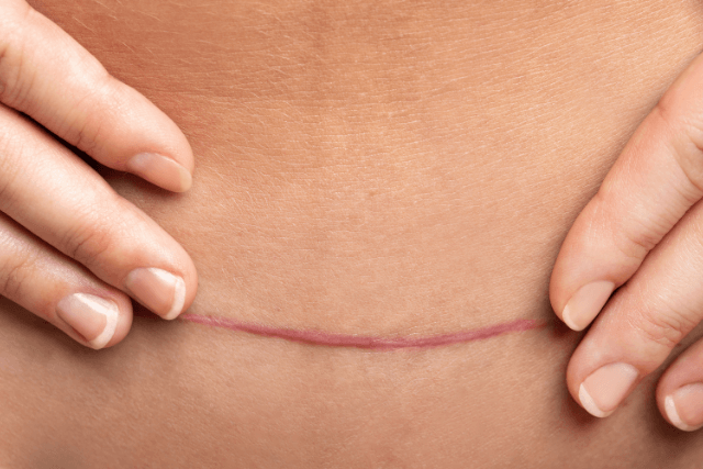Tummy Tuck Scars