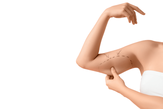 Arm Lift Recovery: Complete Brachioplasty Healing