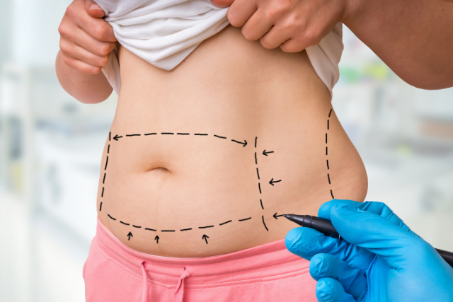 Liposuction Vs Weight Loss