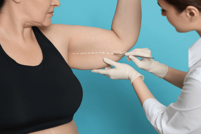 Arm Fat Removal