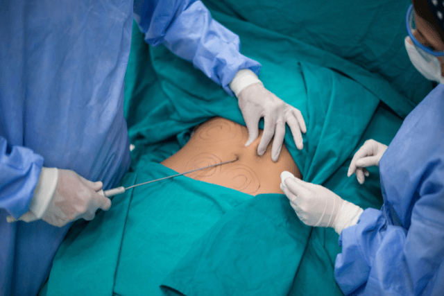How painful is liposuction surgery?