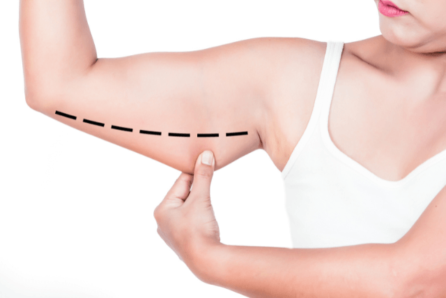 What Are the Benefits of Arm Fat Removal?