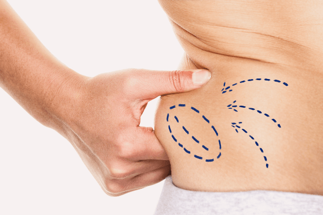 How Long Does Liposuction Last?