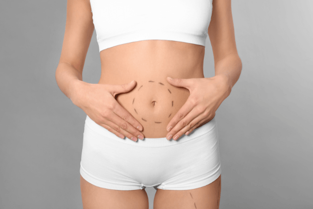 Mons Lift With Tummy Tuck