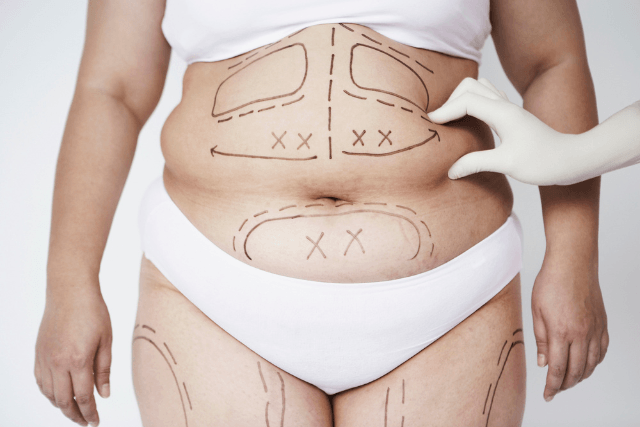 CoolSculpting vs. Liposuction