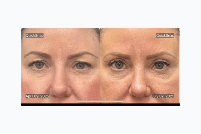 How Much Does Blepharoplasty Cost?