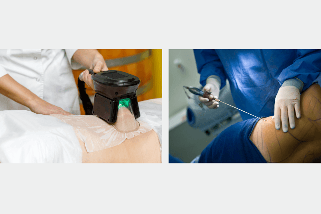 Liposuction vs Freezing Fat