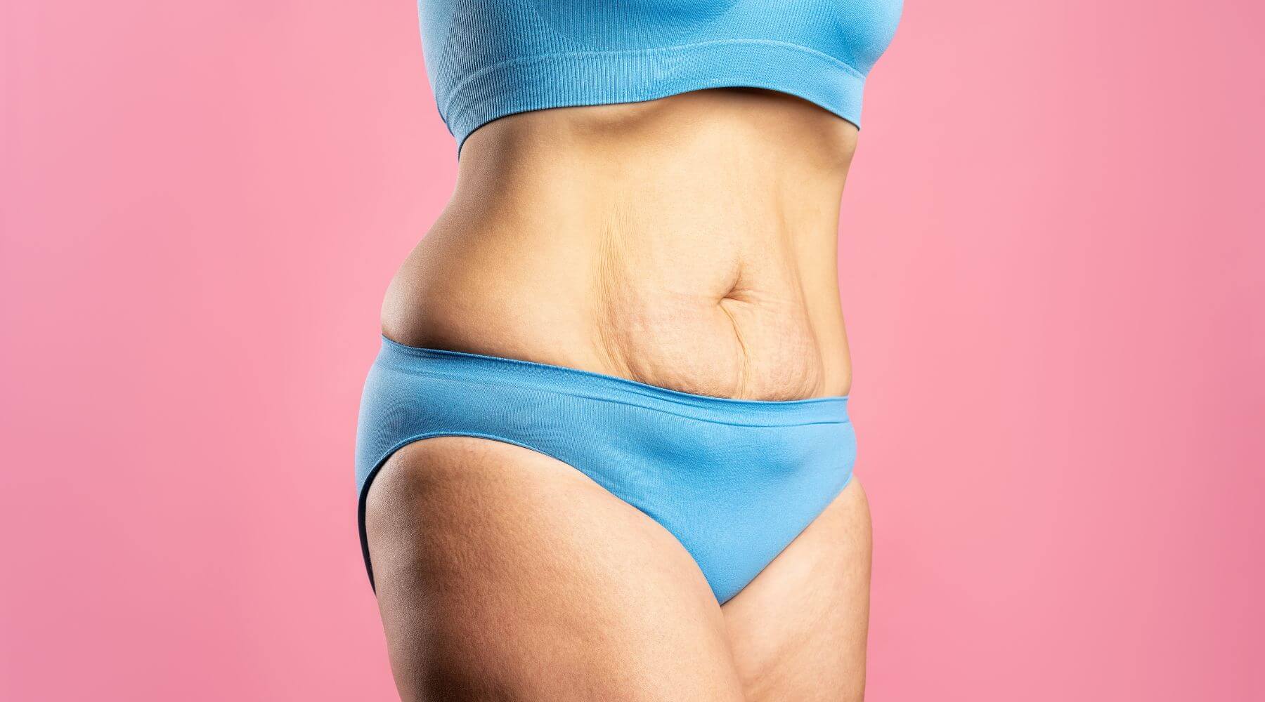 Understanding the 'Apron Belly'
