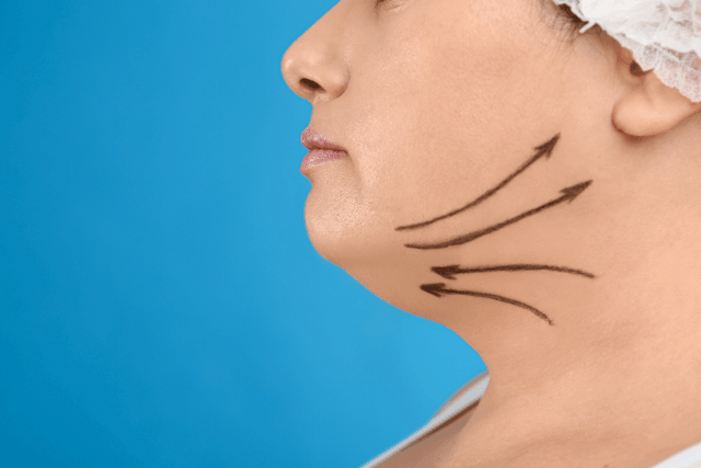 Treatments For Double Chin